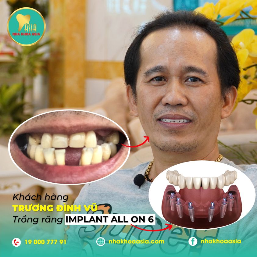 Nha Khoa City Smiles - Trồng Răng Implant, Bọc Răng Sứ, Riềng Răng Uy Tín Tại HCM 37