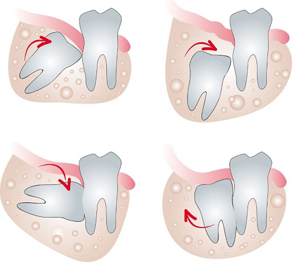 Hình ảnh răng khôn có chỉ định nhổ răng