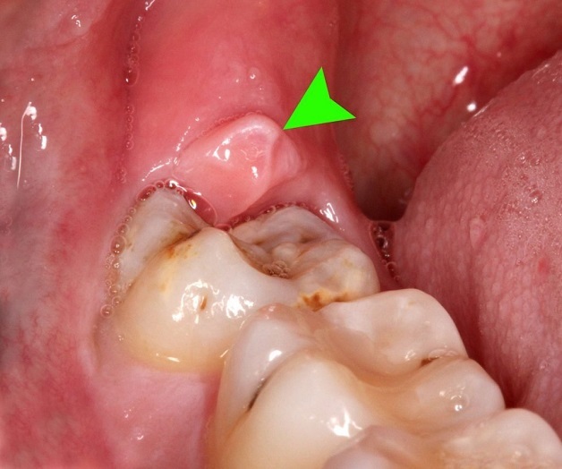 Viêm lợi trùm răng khôn có thể tự hết không? Mất bao lâu để khỏi?