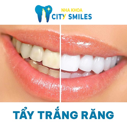 Hình ảnh về dịch vụ tẩy trắng răng tại Nha Khoa City Smiles