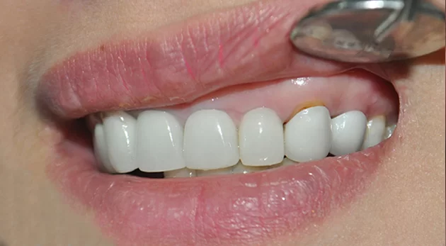 Quá trình thực hiện bọc răng sứ không đúng kỹ thuật. 