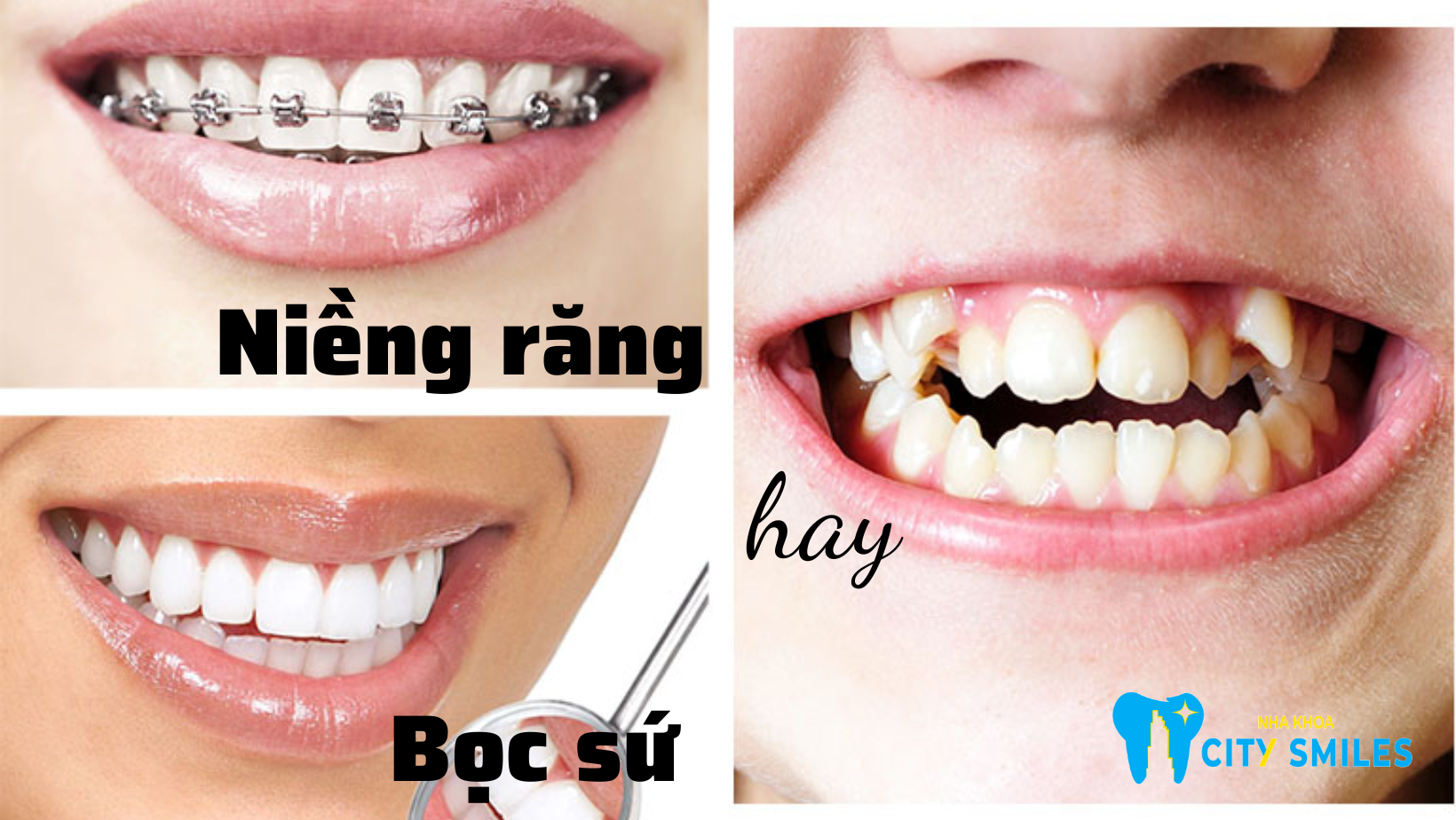 Nên niềng răng hay bọc sứ?