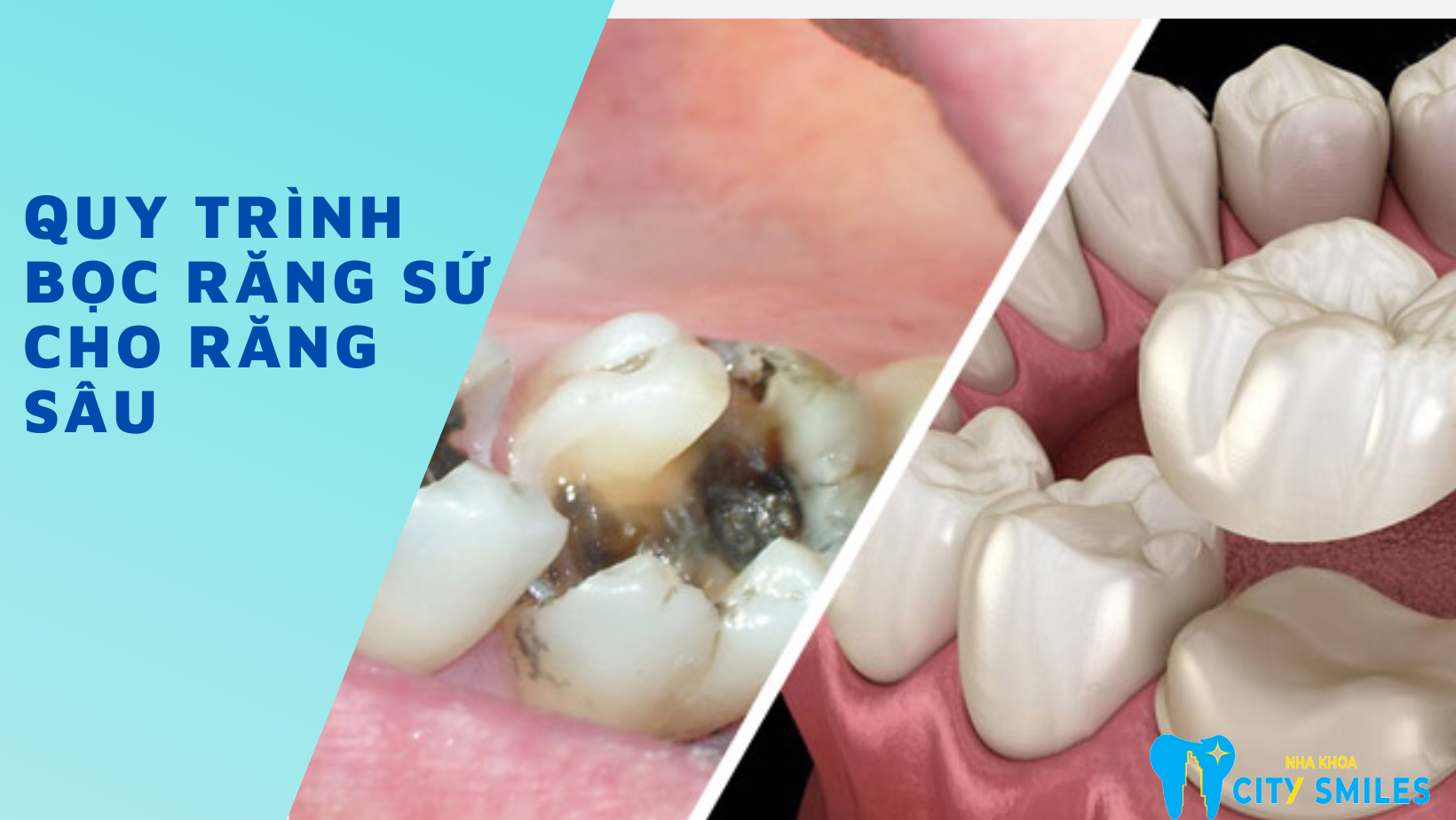 Quy trình bọc răng sứ cho răng sâu