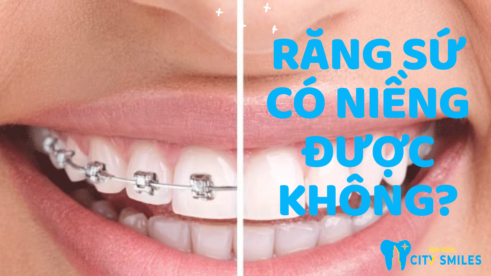 [Giải đáp] Sau khi bọc răng sứ có niềng được không?