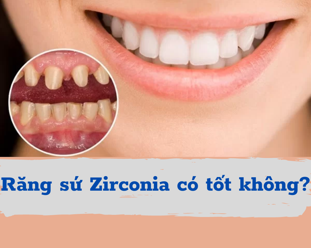 Răng sứ Zirconia là gì? Có tốt không? Có mấy loại?