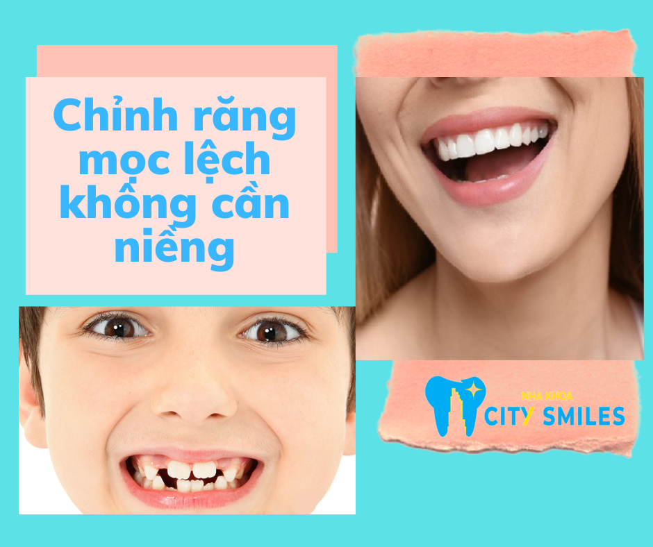 Các phương pháp chỉnh răng mọc lệch không cần niềng