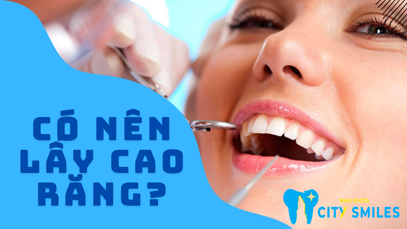 Có nên lấy cao răng?