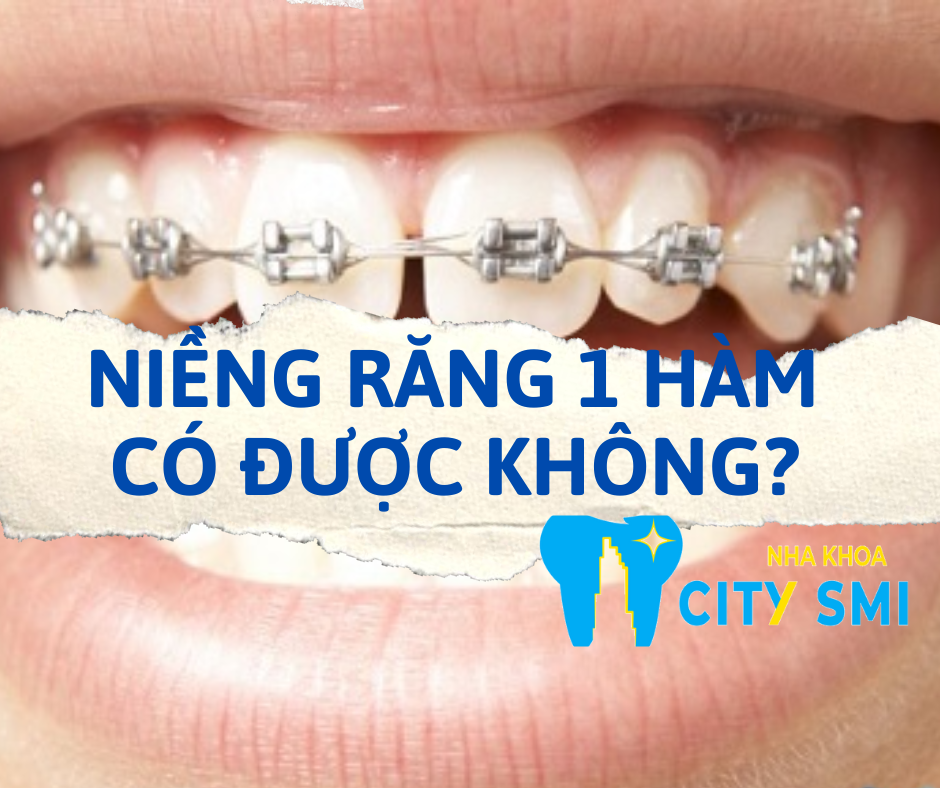 Niềng răng 1 hàm có được không?