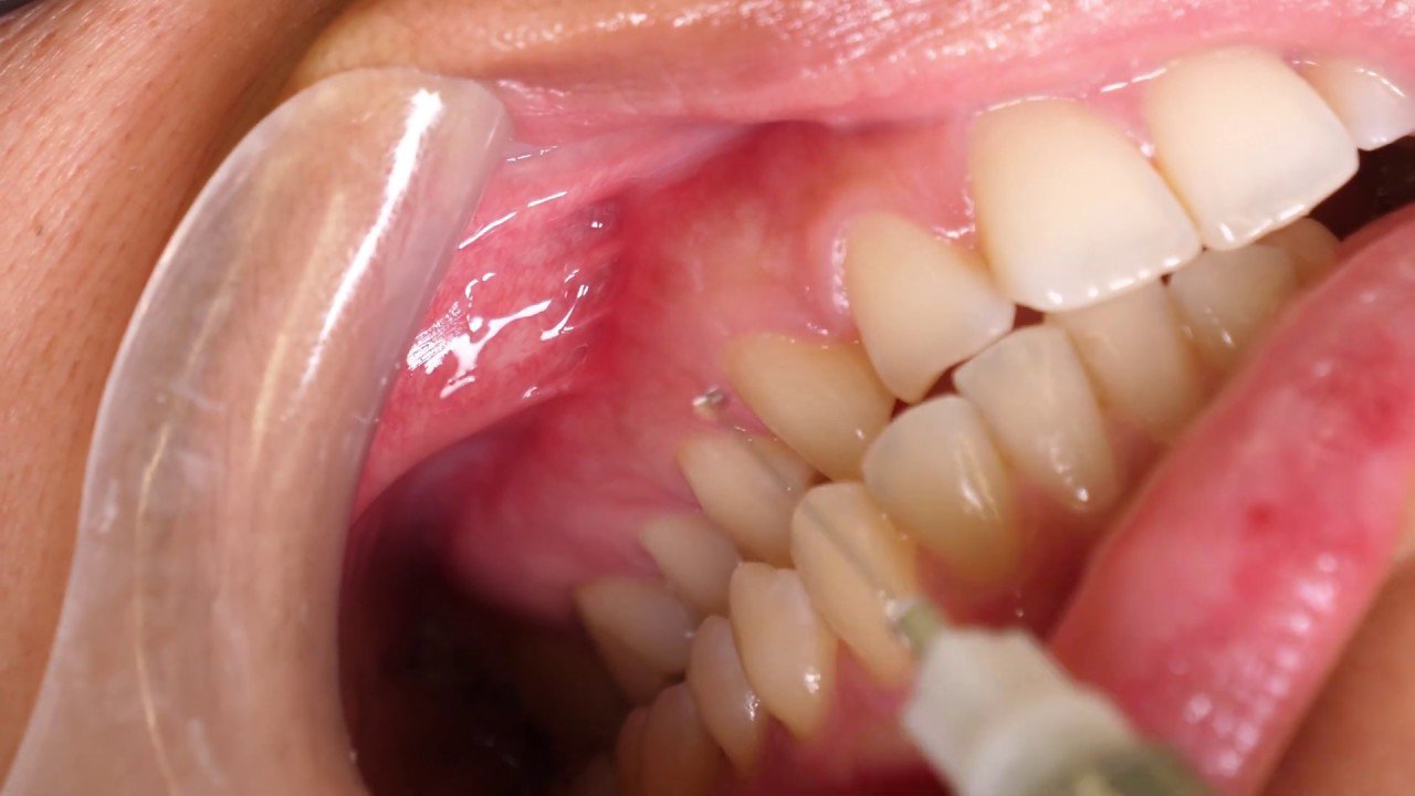 Phương pháp gây tê khi nhổ răng