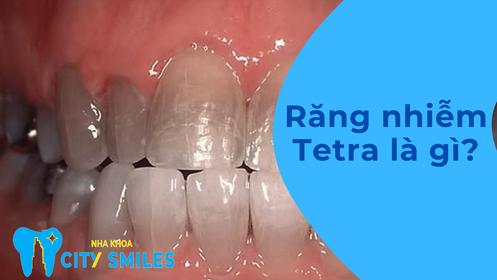 Răng nhiễm Tetra là gì?