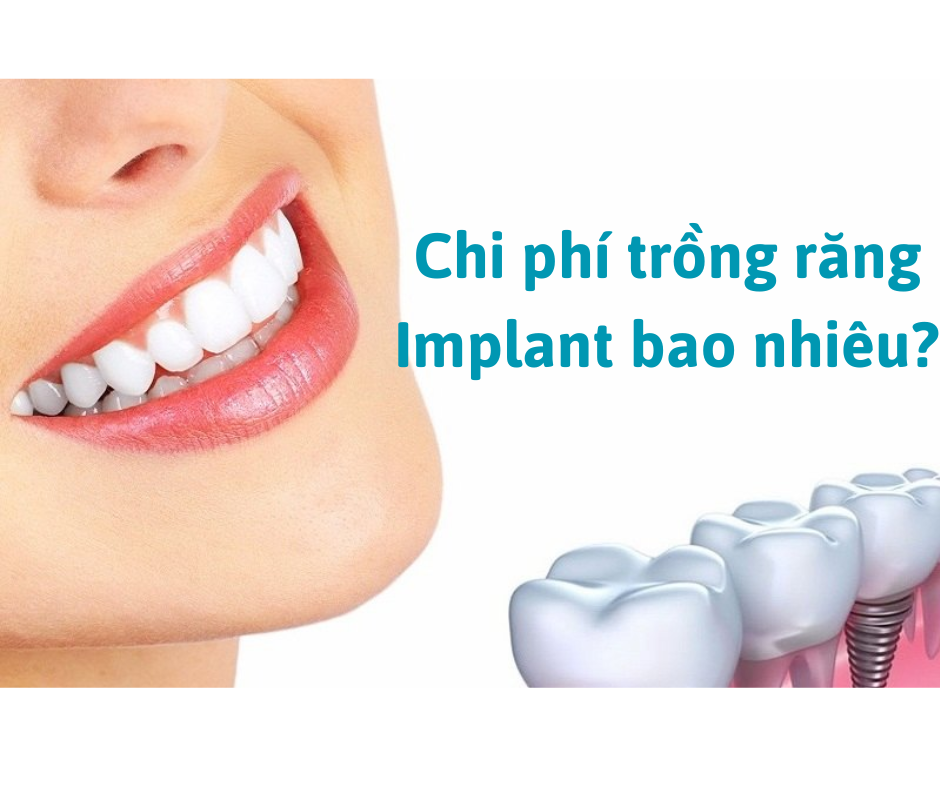 Chi phí trồng răng Implant bao nhiêu Trồng răng Implant có được lâu không