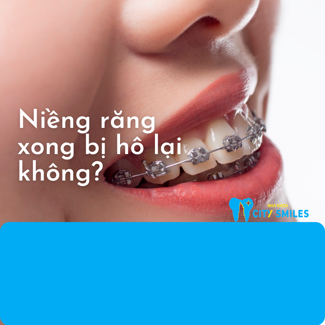 Niềng răng xong bị hô lại không?