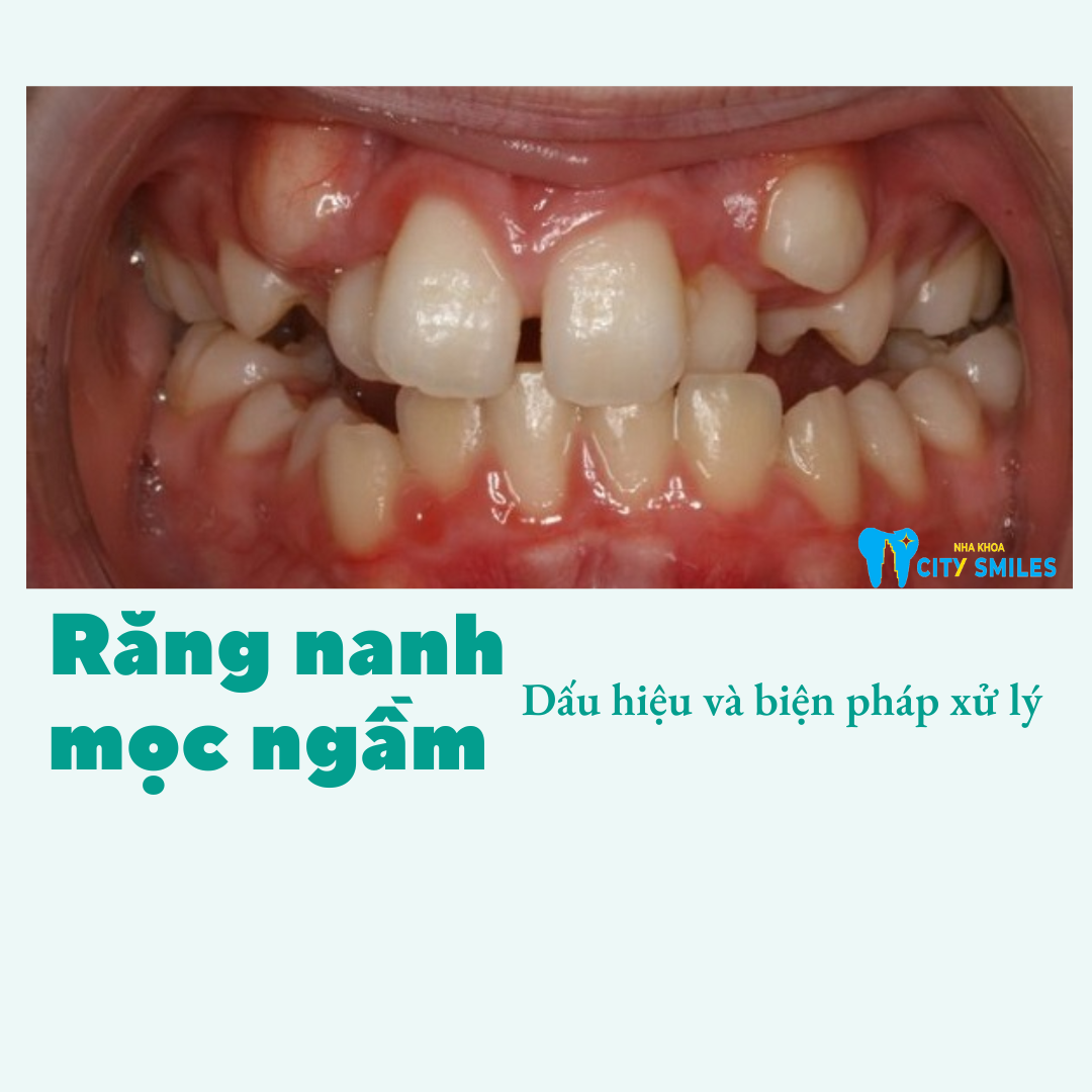 Răng nanh mọc ngầm có nên nhổ không? Điều cần lưu ý