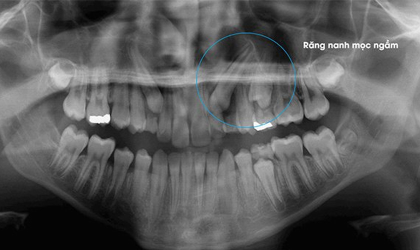 Răng nanh mọc ngầm là gì?