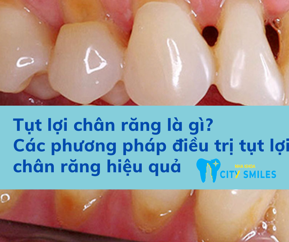 Tụt lợi chân răng là gì Các phương pháp điều trị tụt lợi chân răng