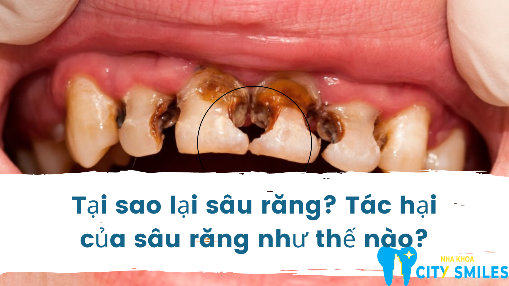 Tại sao lại sâu răng? Tác hại của sâu răng như thế nào?