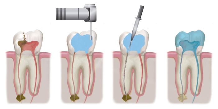 Tùy từng trường hợp, bác sĩ nha khoa sẽ đánh giá tình trạng răng và tủy răng để điều trị