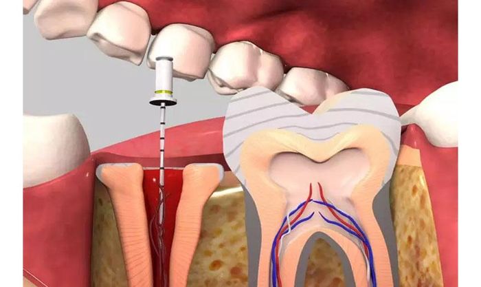 Lấy tủy răng có đau không