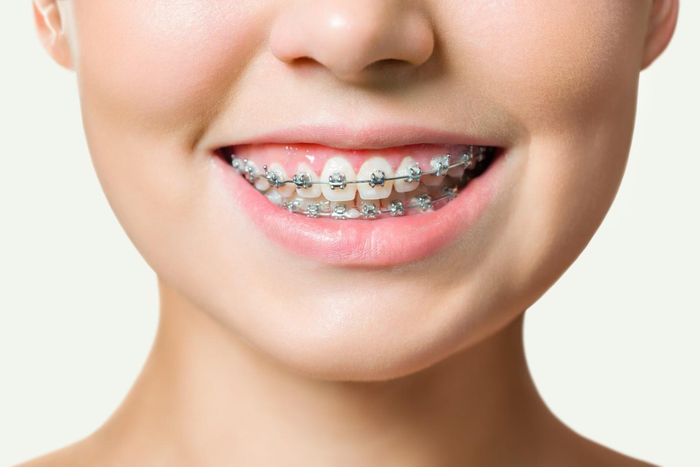 Yên tâm niềng răng chất lượng, giá tốt tại Nha Khoa City Smiles