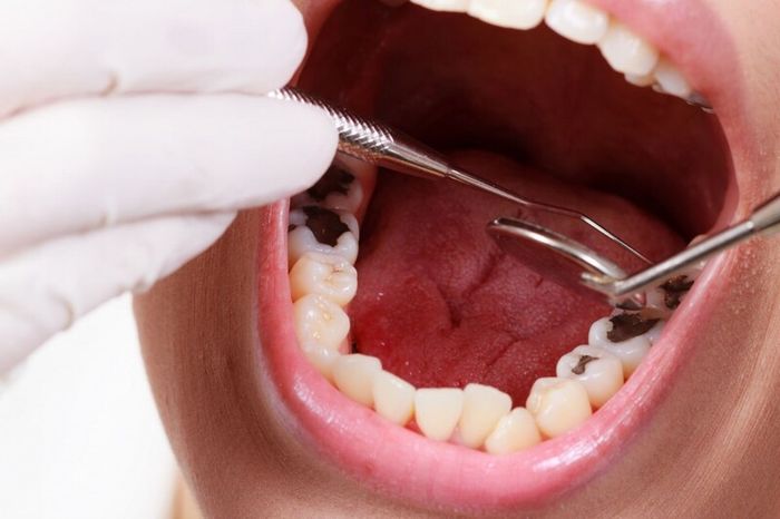cách trị nhức răng có lỗ