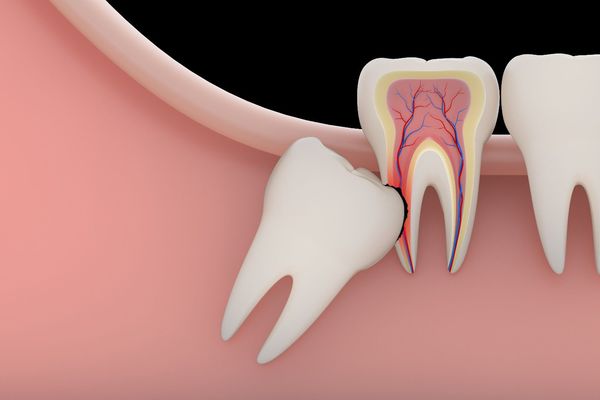 Có nên nhổ răng khôn không? Khi nào cần thiết nhổ?