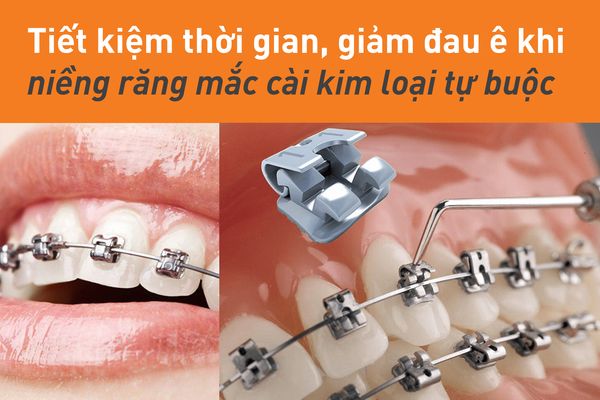 niềng răng mắc cài kim loại 5