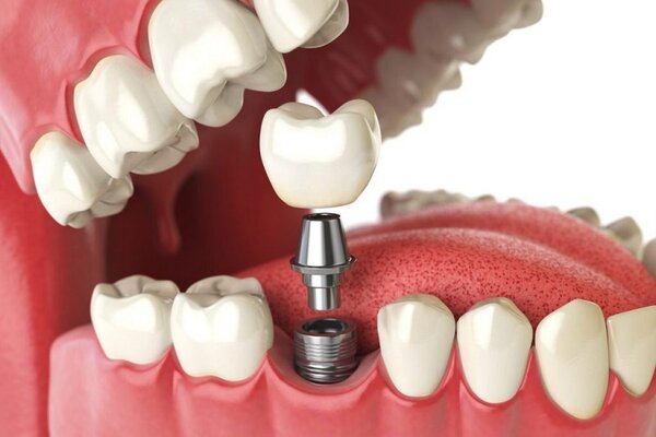 Dịch vụ trồng răng implant