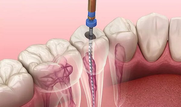 Lấy tủy răng nhiễm trùng để ngăn ngừa mất răng