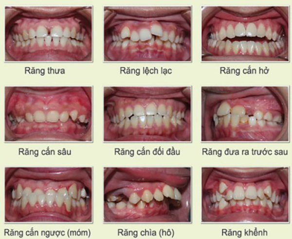 Các trường hợp nên niềng răng