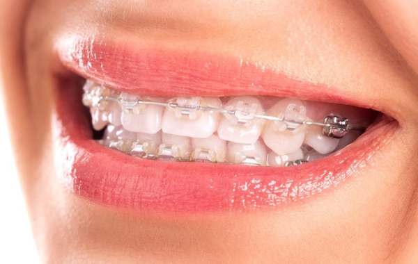 Răng móm có thể khắc phục được nhờ phương pháp niềng răng