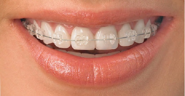 Niềng răng mắc cài sứ hoặc pha lê có tính thẩm mỹ cao hơn giúp tự tin trong giao tiếp