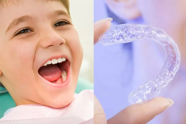 Khay niềng trong suốt Invisalign là sự lựa chọn hiện đại và tiện lợi cho trẻ em 15 tuổi