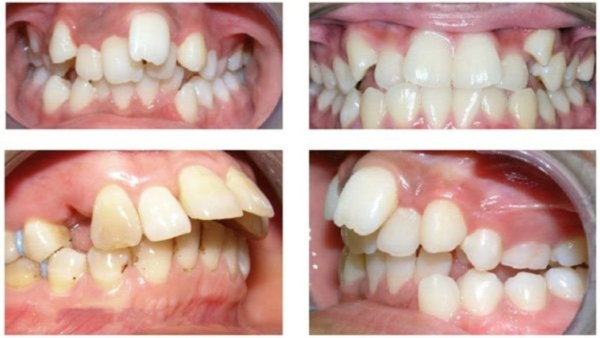 Răng hô, vẩu là một trường hợp cần cắm vít niềng răng