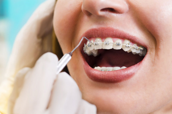Chi phí niềng răng không đơn giản chỉ dựa vào một yếu tố duy nhất mà phải xem xét toàn diện từ nhiều khía cạnh khác nhau