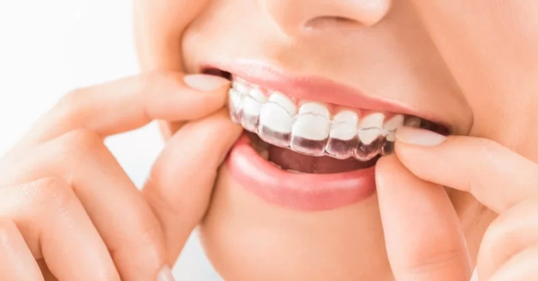 Khay niềng trong suốt Invisalign là một sự lựa chọn hiện đại cho việc niềng răng thẩm mỹ