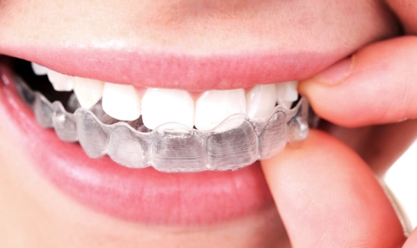 Invisalign là một phương pháp niềng răng hiện đại và thẩm mỹ