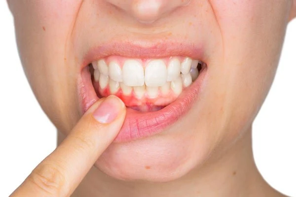Răng không đều, hàm không khớp gây ra việc nghiến răng khi ngủ