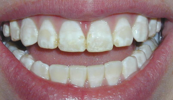 Nghiến răng khi ngủ gây tác hại hỏng răng và mòn men răng, ảnh hưởng đến ngoại hình và làm suy yếu cấu trúc răng