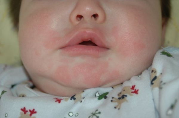 Trẻ cũng có thể nổi các vết mẫn đỏ ngoài da trong giai đoạn mọc răng