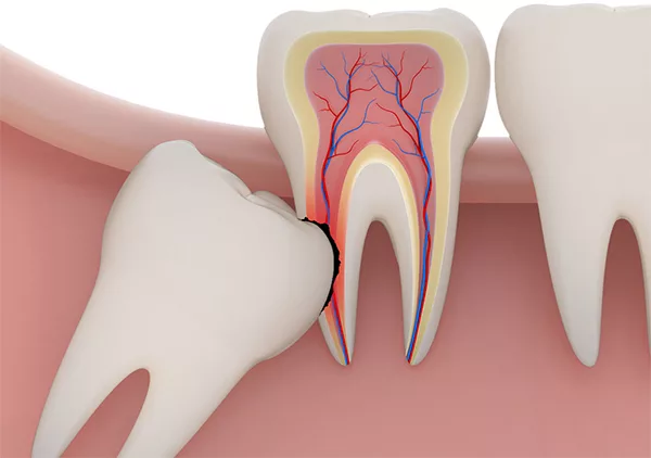 Răng khôn thường gây ra các vấn đề như đau đớn, sưng nướu