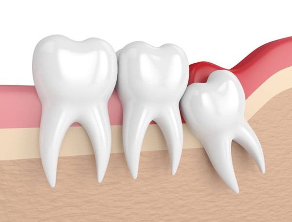 Mọc răng khôn có thể gây ra sự sưng nướu và đau đớn