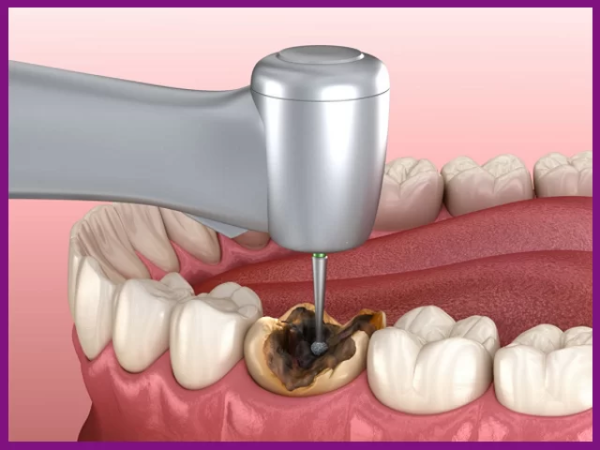 Cách điều trị răng sâu vào tủy như thế nào?