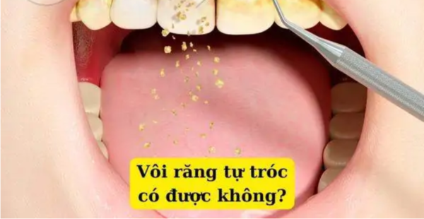 Cách làm cao răng rơi hay vôi răng tự tróc hiệu quả như thế nào?