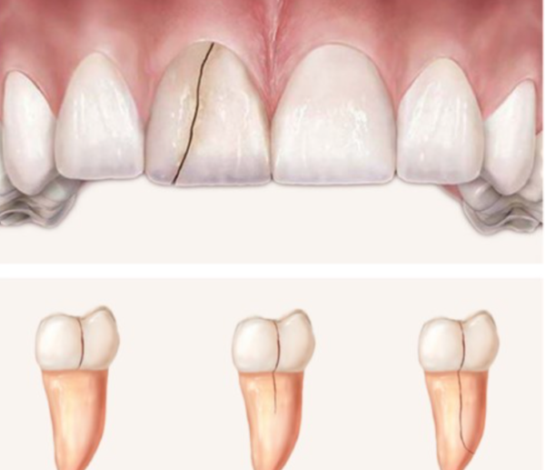 Răng bị nứt là tình trạng như thế nào?