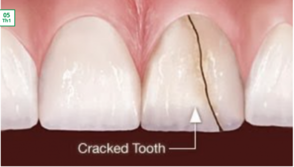 Các dấu hiệu nhận biết và nguyên nhân dẫn đến răng bị nứt