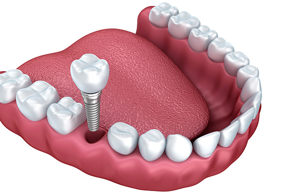 Trồng răng implant là một phương pháp tiên tiến và hiệu quả để có tướng răng rồng đại phú quý