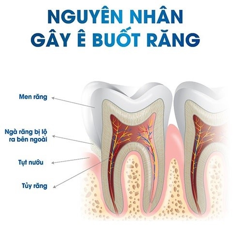 Những nguyên nhân gây ê buốt răng hàm dưới