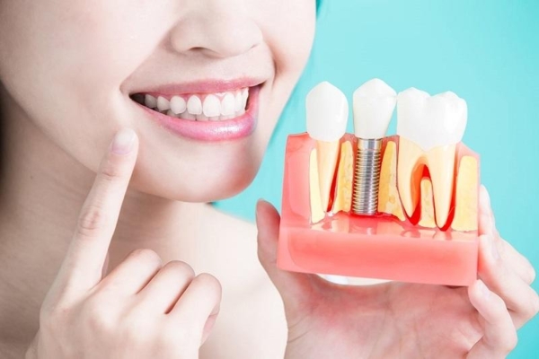 Có nên trông răng Implant cho trẻ 14 tuổi không?