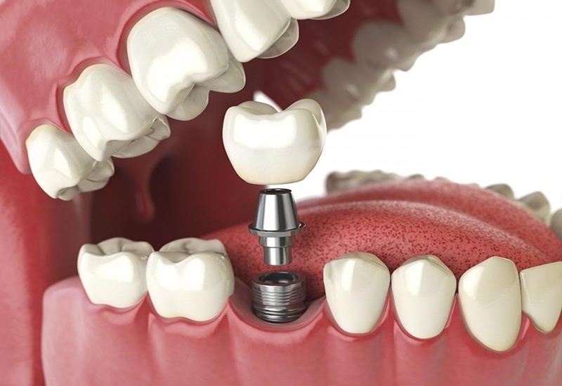 Trồng răng hàm bị sâu bằng cấy ghép implant