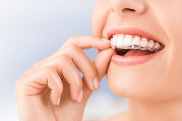 Quy trình các bước niềng răng Invisalign chuẩn nhất